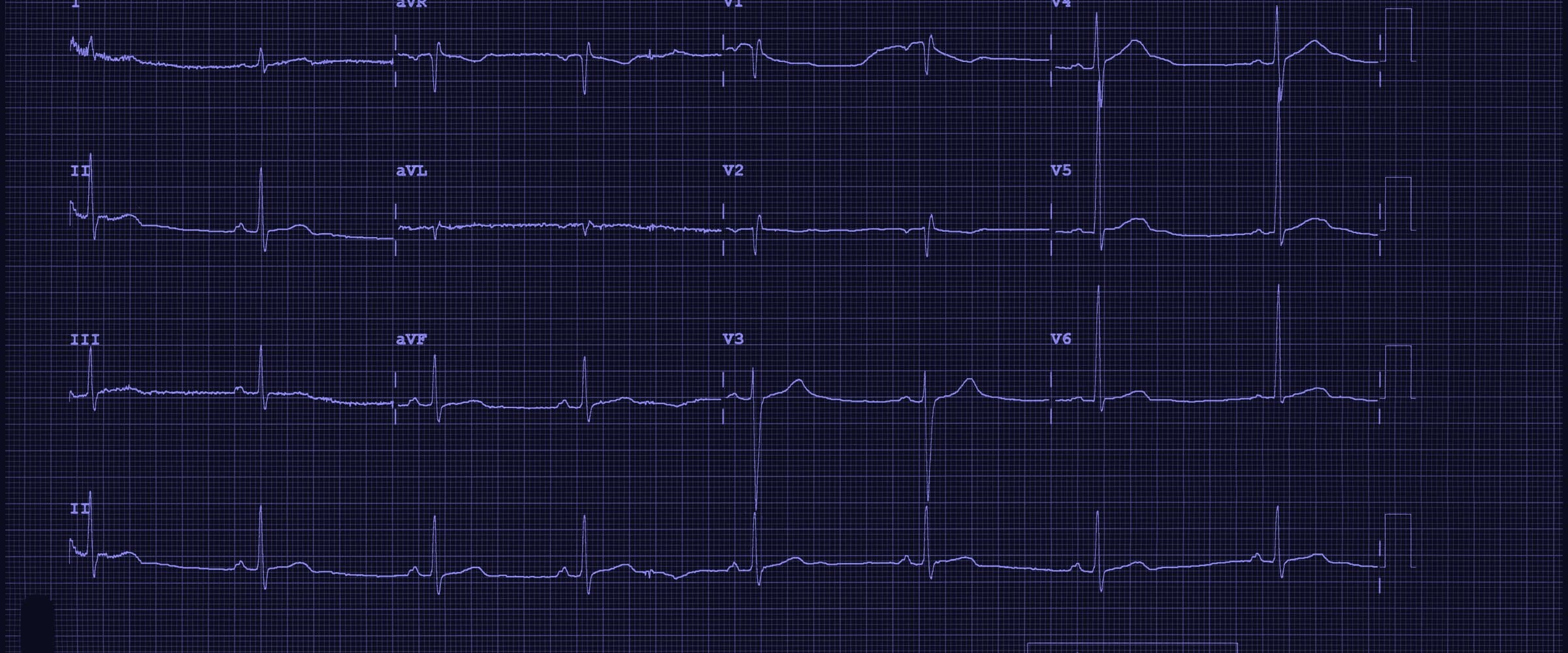 A 12-lead electrocardiogram tracing on chart paper.